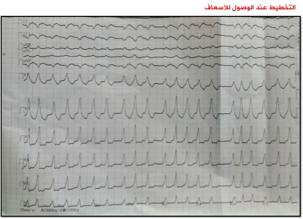 تشخيص وتدبير حالة متلازمة ولف باركنسون وايت مع رجفان أذيني 1