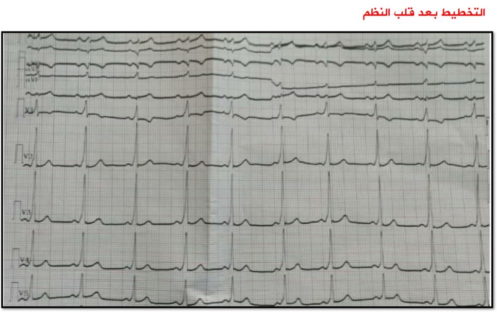 تشخيص وتدبير حالة متلازمة ولف باركنسون وايت مع رجفان أذيني 2
