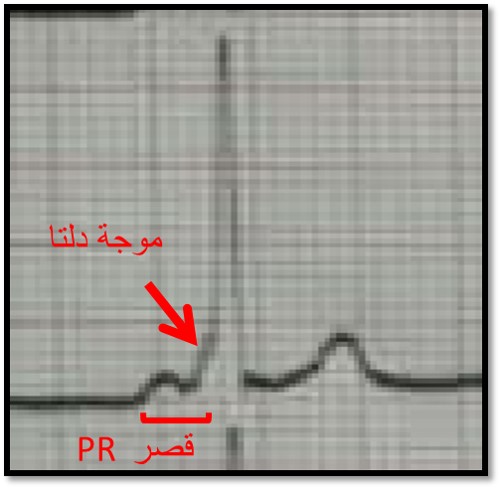 تشخيص وتدبير حالة متلازمة ولف باركنسون وايت مع رجفان أذيني 3