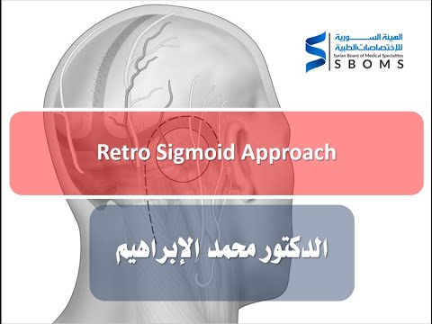 Retro Sigmoid Approach الهيئة السورية للاختصاصات الطبية SBOMS