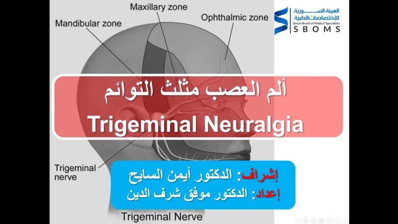 ألم مثلث التوائم Trigeminal Neuralgia الهيئة السورية للاختصاصات الطبية SBOMS