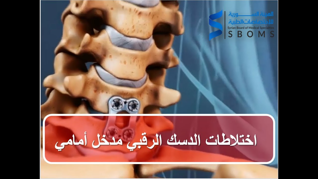 اختلاطات الدسك الرقبي مدخل أمامي الهيئة السورية للاختصاصات الطبية SBOMS