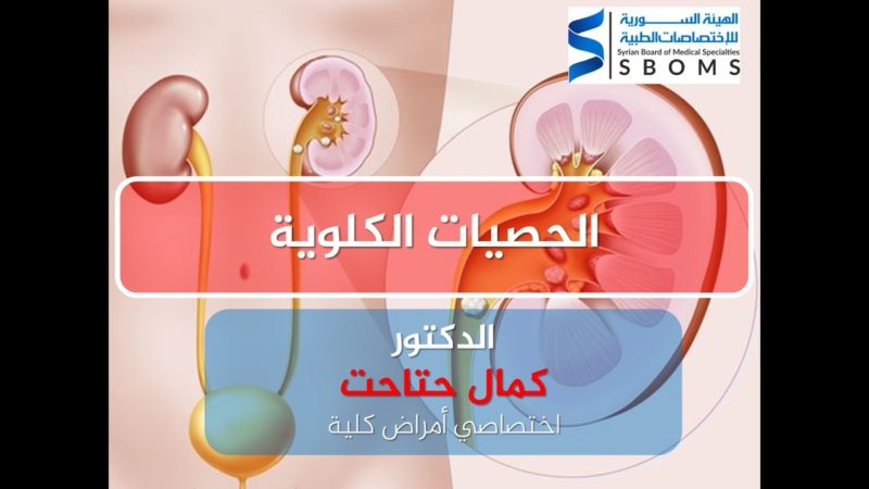 الهيئة السورية للاختصاصات الطبية الحصيات البولية