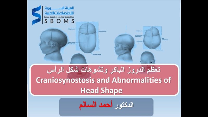 تعظم الدروز الباكر وتشوهات شكل الرأس Craniosynostosis and Abnormalities of Head Shape الهيئة السورية للاختصاصات الطبية SBOMS