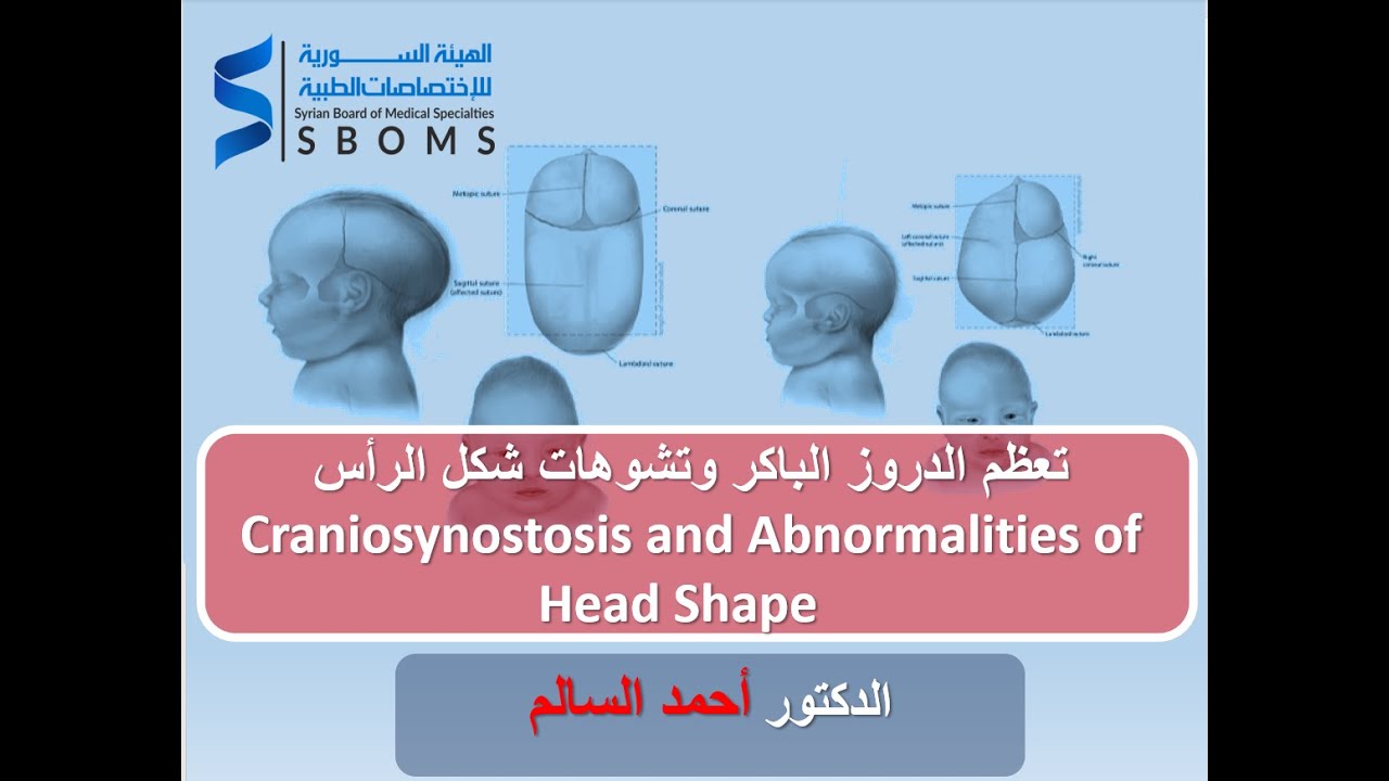 تعظم الدروز الباكر وتشوهات شكل الرأس Craniosynostosis and Abnormalities of Head Shape الهيئة السورية للاختصاصات الطبية SBOMS