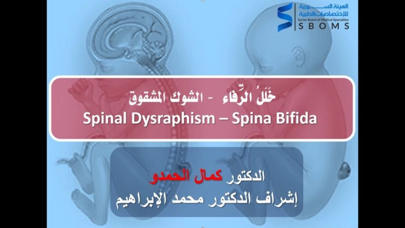 خلل الرفاء - الشوك المشقوق Spinal Dysraphism - Spina Bifida الهيئة السورية للاختصاصات الطبية SBOMS
