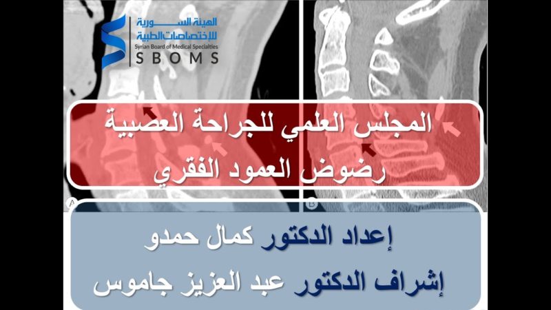 رضوض العمود الفقري الرقبي الهيئة السورية للاختصاصات الطبية SBOMS